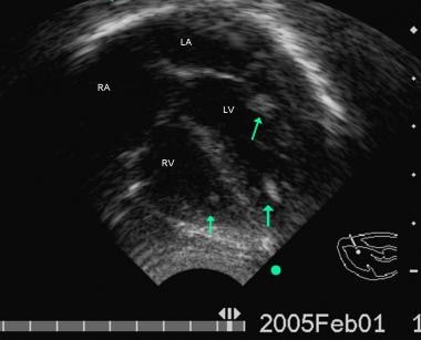 Follow-up echocardiographic 4 chamber view from th