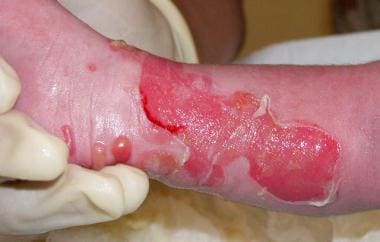 epidermolysis bullosa dystrophica