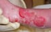 Pediatric Epidermolysis Bullosa