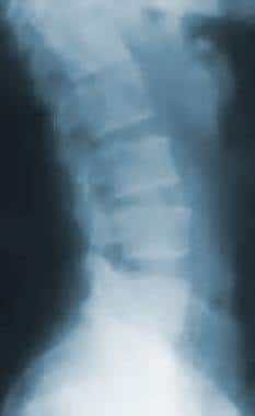Radiograph of the lumbar spine. This image demonst