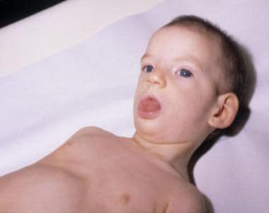 Child with cri-du-chat syndrome. Note the hyperton
