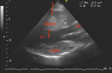 Echocardiogram of a patient with Danon disease and
