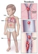 Pediatric Thromboembolism