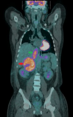 Coronal fused 18F-FDG PET/CT image showing a large