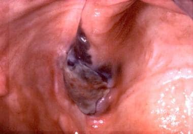 malignant melanoma mouth