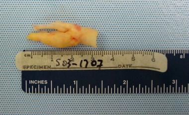 Gross pathologic specimen shows carotid plaque as 
