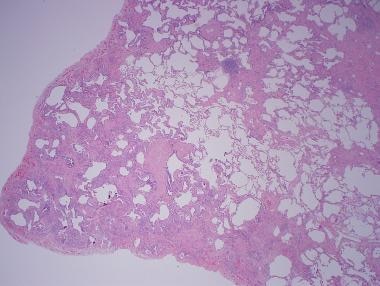 Low-power histology demonstrating subpleural and i