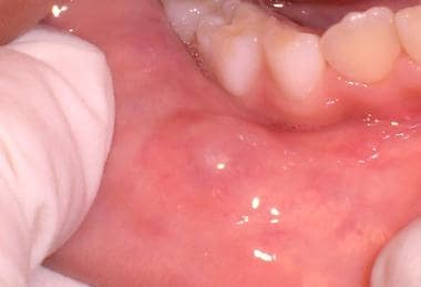Mucocele or mucous retention phenomenon lower lip.