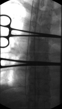 Measuring of required line length, using right bro