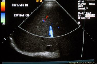 Percutaneous liver biopsy. Hepatic parenchyma and 