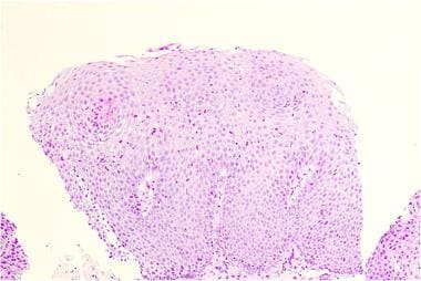 Histology from a patient with eosinophilic esophag