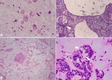Pathology of Pleomorphic Adenoma. Unusual findings
