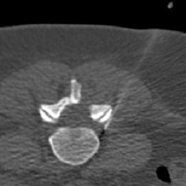 CT fluoroscopic image demonstrates that the tip of
