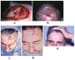 Scalp Reconstruction Procedures