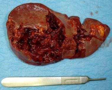 Resected traumatized spleen with multiple lacerati