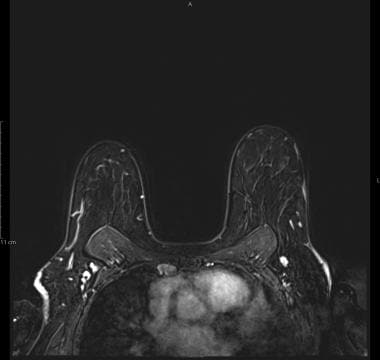 Same patient as in the previous MRI: Axial T1 fat-