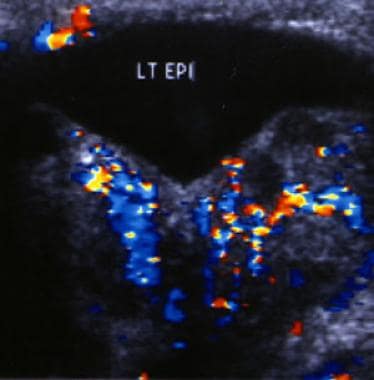 Color Doppler sonogram of the left epididymis in a