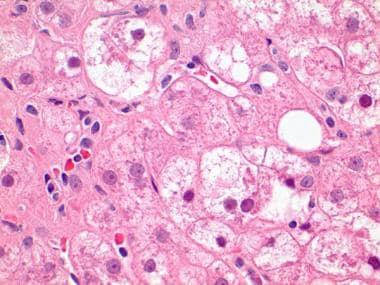 Higher magnification shows ballooned hepatocytes t