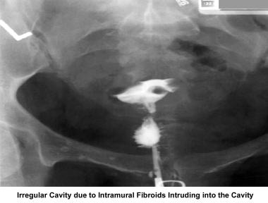 Infertility. Irregular cavity due to intramural fi