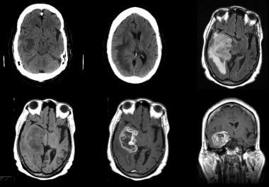 Grade IV astrocytoma in a 73-year-old man. Top row