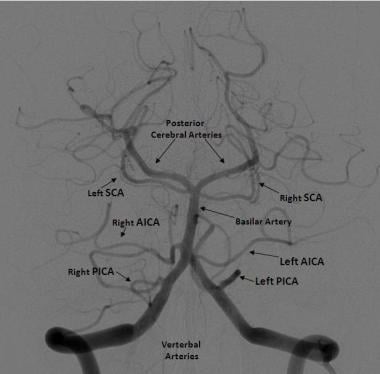 Frontal projection from a right vertebral artery a