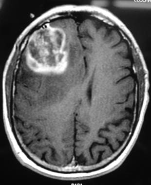 brain tumor mri without contrast