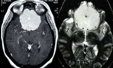 Subsequent MRI of the previous CT with the followi