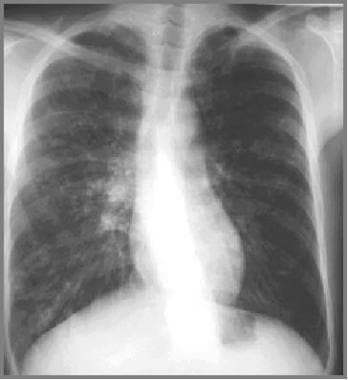 Cystic fibrosis, thoracic. Image in a 27-year-old 