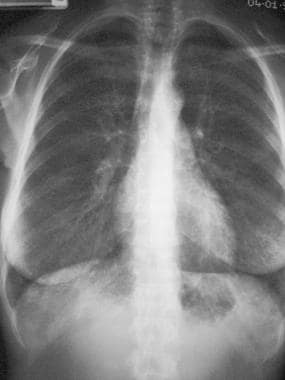 Posteroanterior (PA) chest radiograph shows bilate