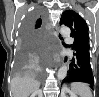Coronal CT scan in a patient with breast cancer sh