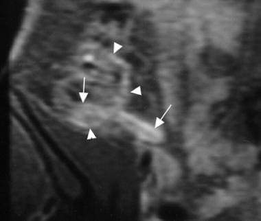 Acute suppurative appendicitis in a 15-year-old bo