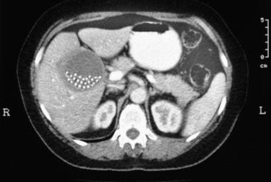 CT scan shows pearl gallstones and thickening of t