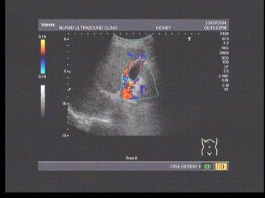 Color Doppler ultrasound showing pericholecystic v