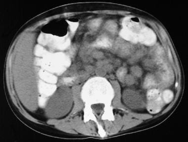 CT scan of the abdomen in a patient with AIDS show
