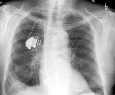 Chest radiograph. Increasing numbers of patients a