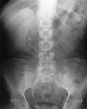 Excretory urogram in a 54-year-old man shows chara