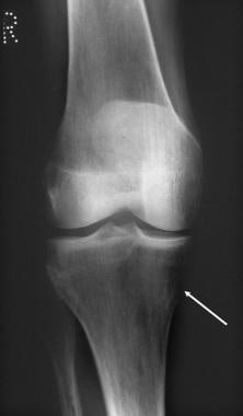 Plain radiograph of the right knee joint in a 52-y