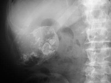 Frontal radiograph of right side of upper abdomen 