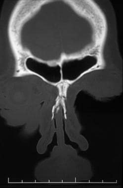Nasal fractures. Coronal CT scan demonstrates a na