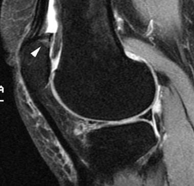 Sagittal T2-weighted image of the knee reveals sub