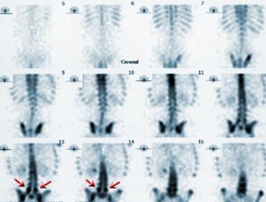 Coronal single-photon emission computed tomography