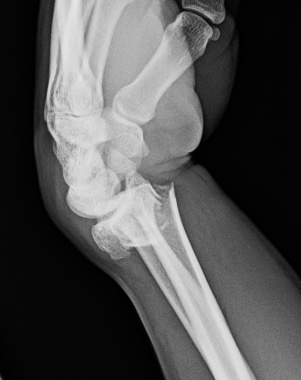 Lateral radiograph demonstrates a comminuted fract