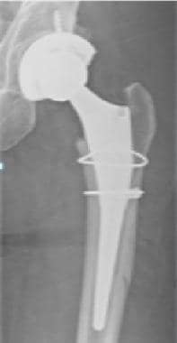 Wedge-shaped femoral stem with intraoperative frac