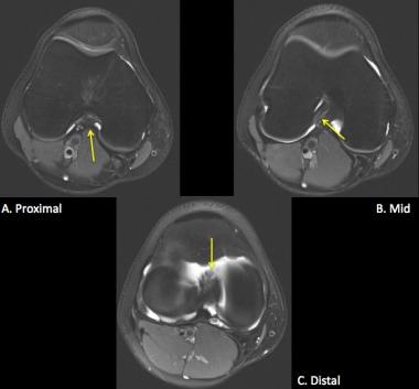 Normal anterior cruciate ligament (ACL) in the axi