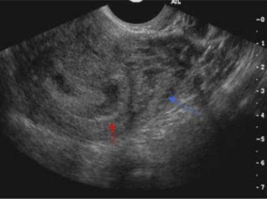 Sagittal endovaginal scan of the uterus demonstrat