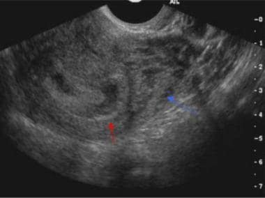 The significance of ultrasound features of sub-chorionic