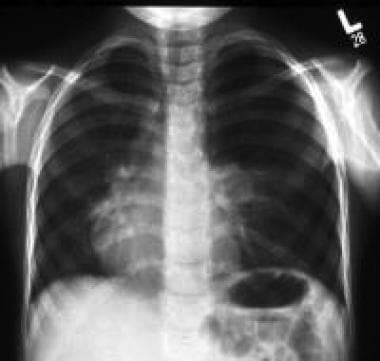 The left upper lobe is affected in 41% of patients