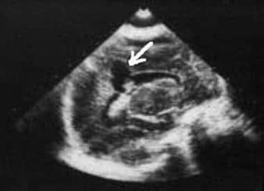 Sagittal ultrasonogram. The images shows cystic en