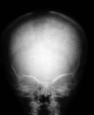Anteroposterior (AP) or preorbital view of the sku