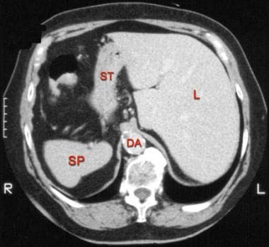 Computed tomography scan of the upper abdomen in a